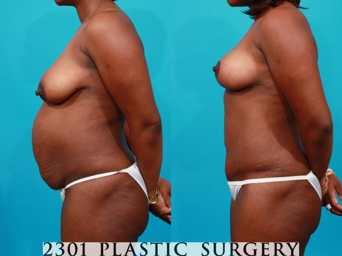 Before & After Tummy Tuck - Extended Case 137 View #2 View in Fort Worth, Plano, & Frisco, Texas