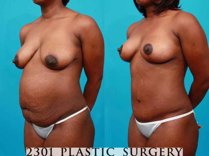 Before & After Breast Lift (Mastopexy) Case 137 View #3 View in Fort Worth, Plano, & Frisco, Texas