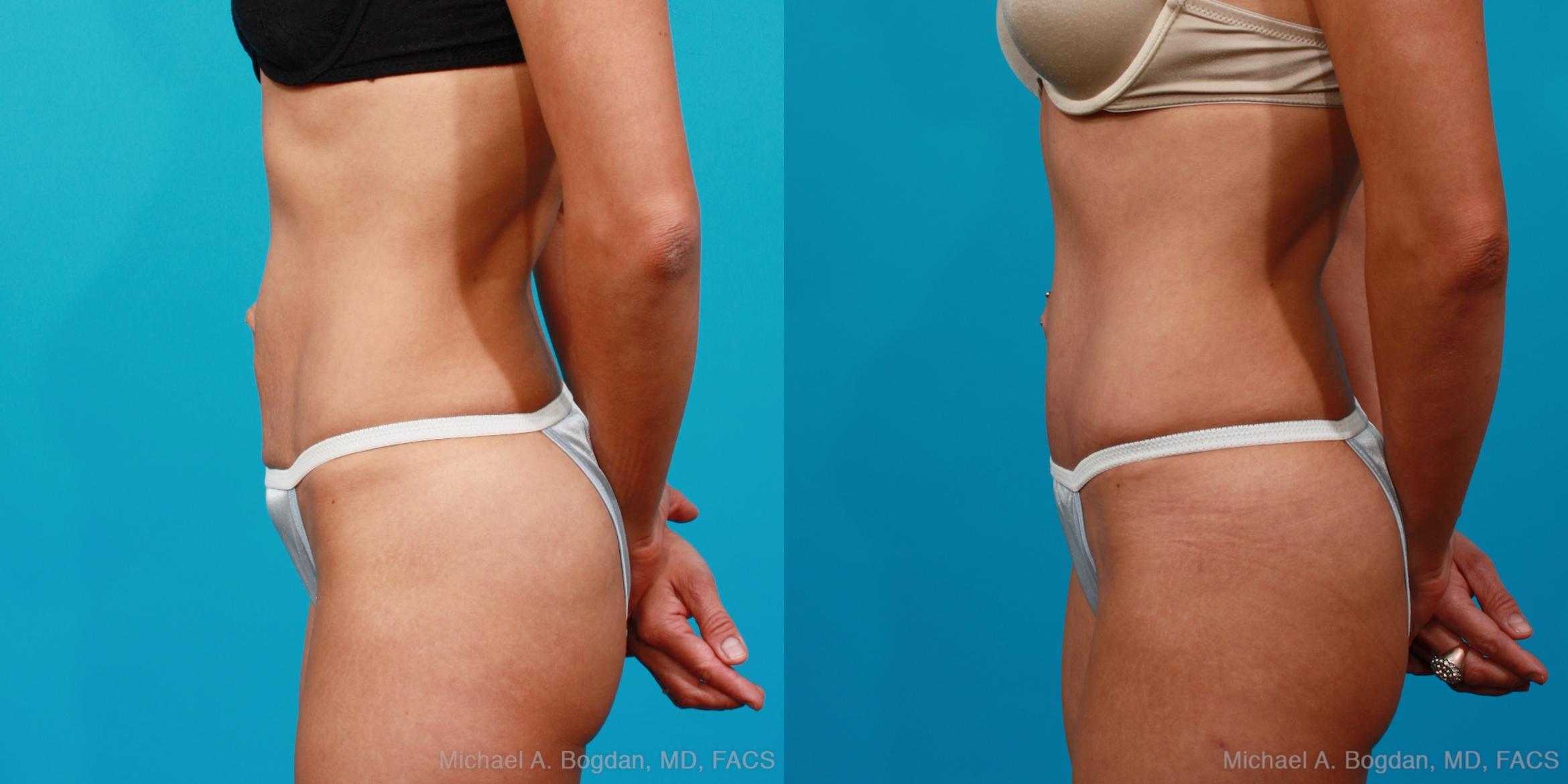 Before & After Tummy Tuck Case 134 View #5 View in Fort Worth & Frisco, Texas