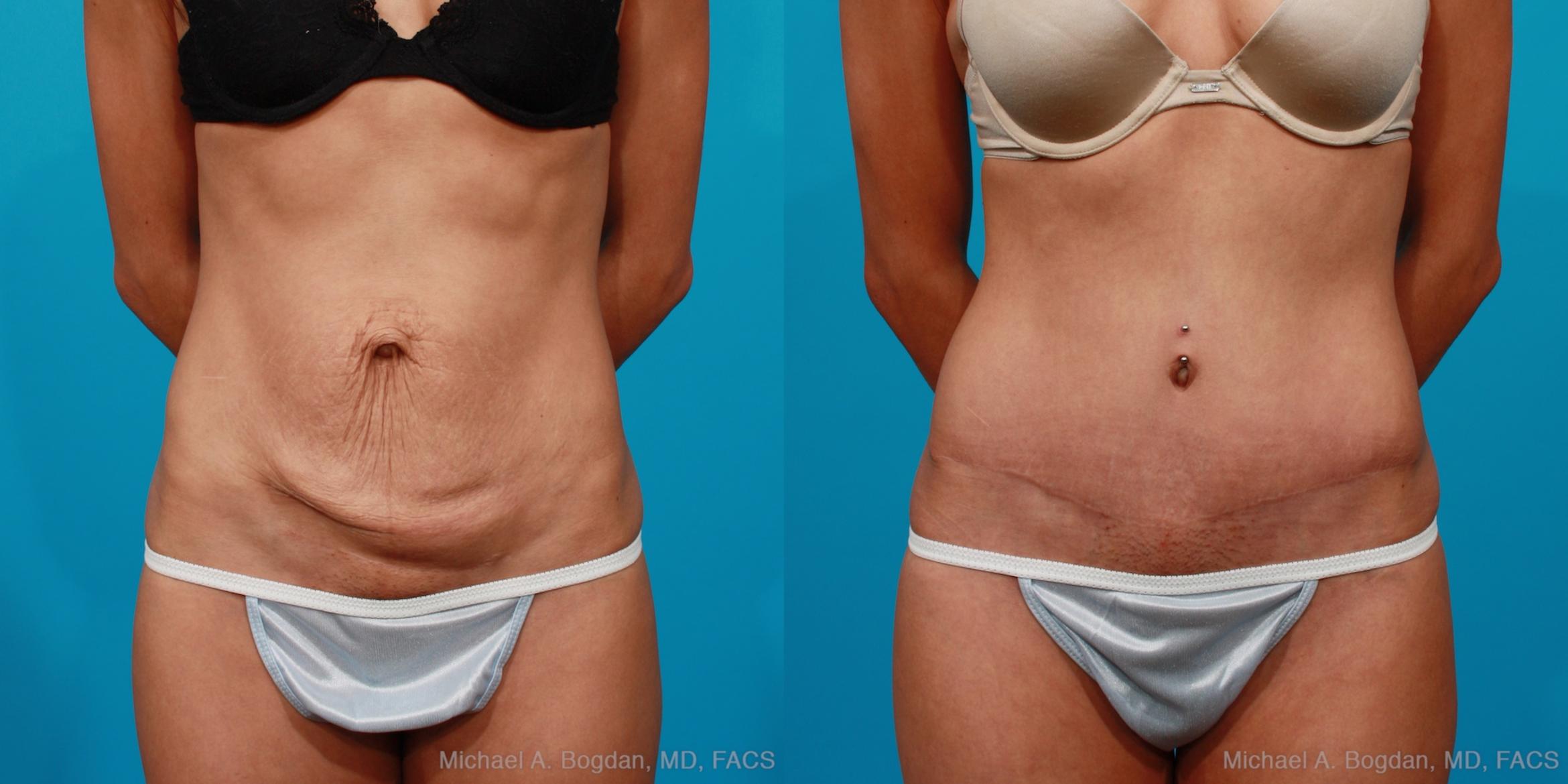 Before & After Tummy Tuck Case 134 View #6 View in Fort Worth & Frisco, Texas