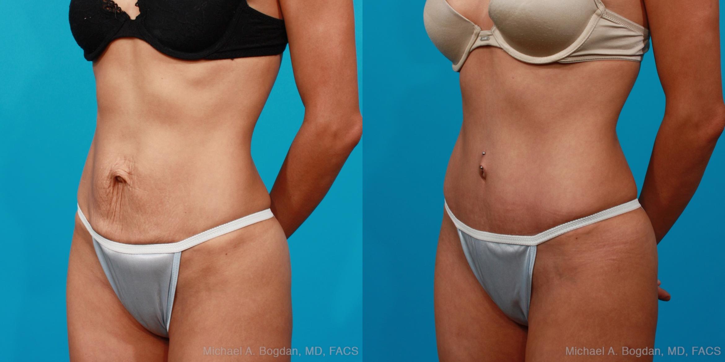 Before & After Tummy Tuck Case 134 View #7 View in Fort Worth & Frisco, Texas