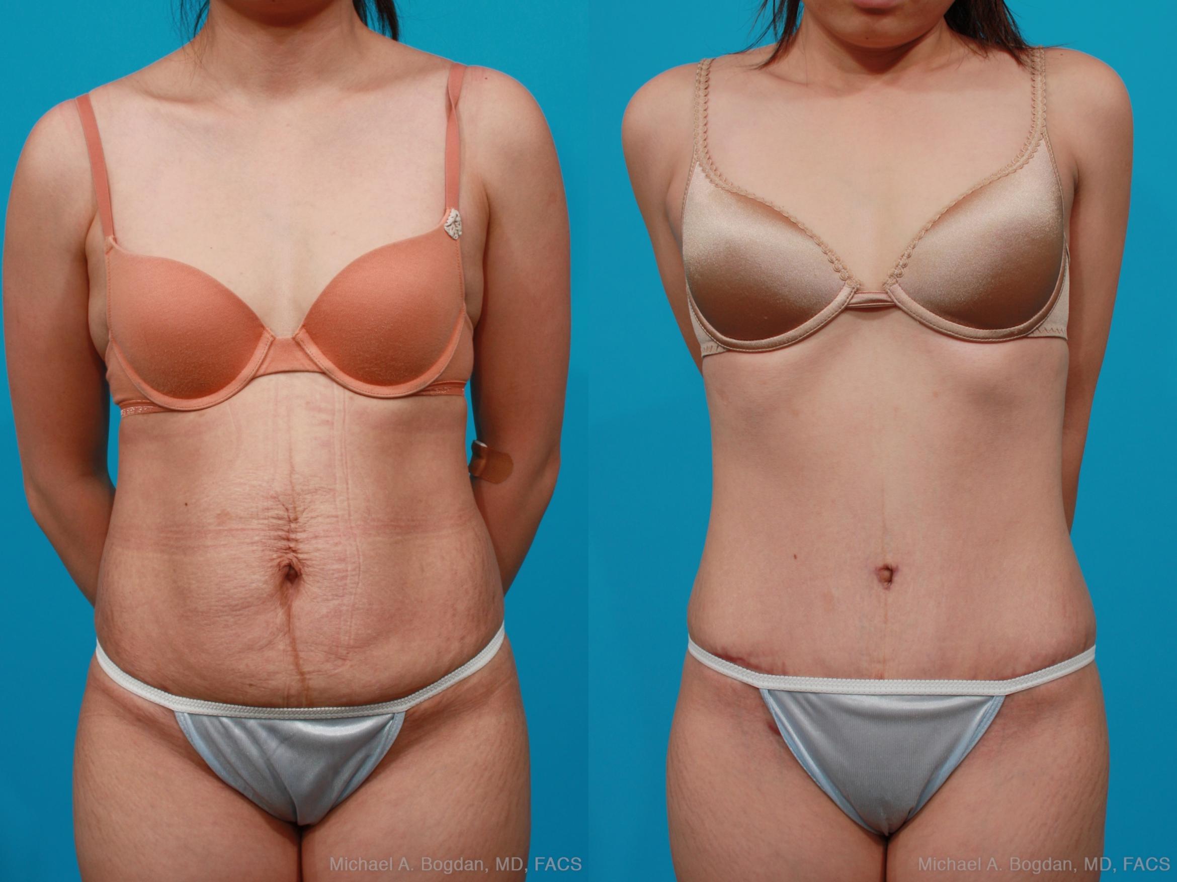 Before & After Tummy Tuck Case 189 View #1 View in Fort Worth & Frisco, Texas