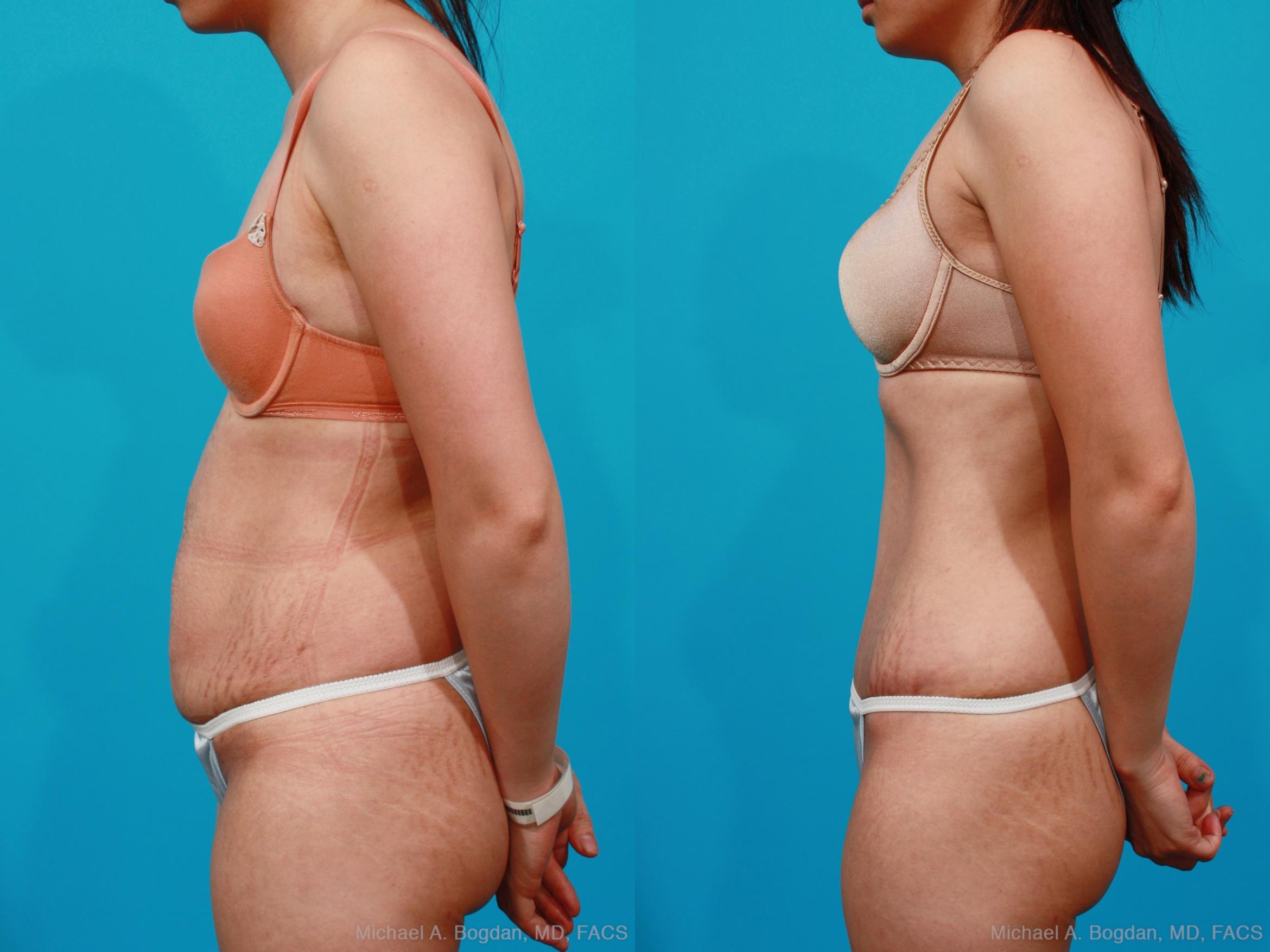 Before & After Tummy Tuck Case 189 View #2 View in Fort Worth & Frisco, Texas