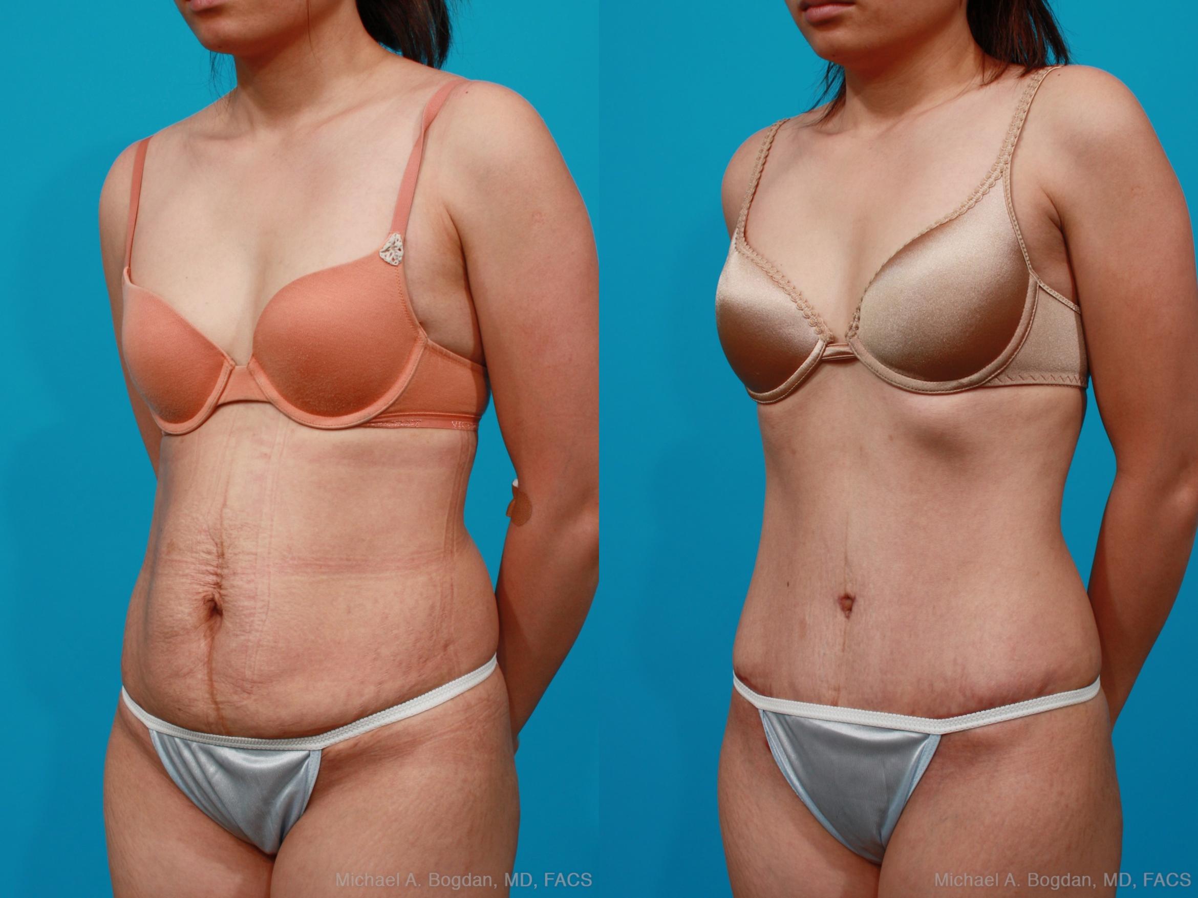 Before & After Tummy Tuck Case 189 View #3 View in Fort Worth & Frisco, Texas