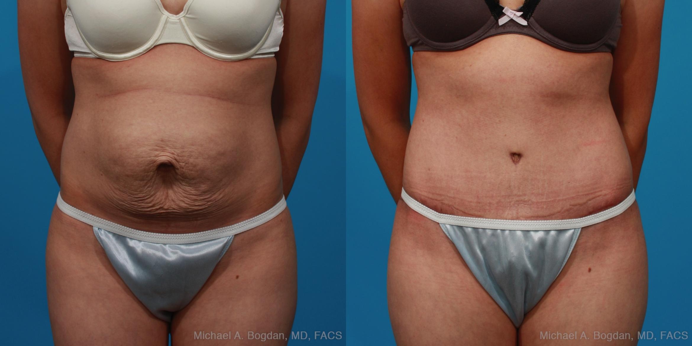 Before & After Tummy Tuck Case 235 View #1 View in Fort Worth & Frisco, Texas
