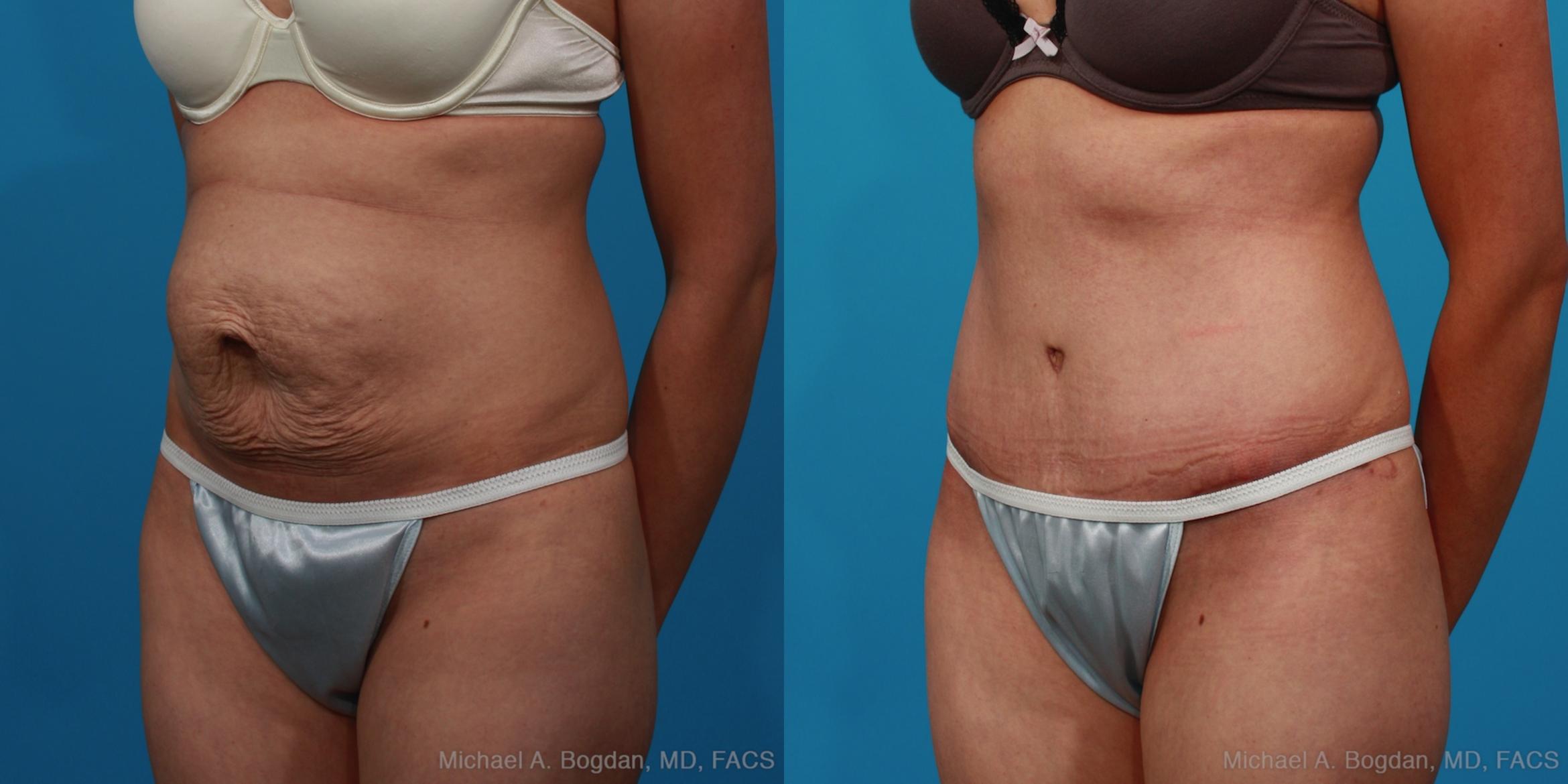 Before & After Tummy Tuck Case 235 View #3 View in Fort Worth & Frisco, Texas