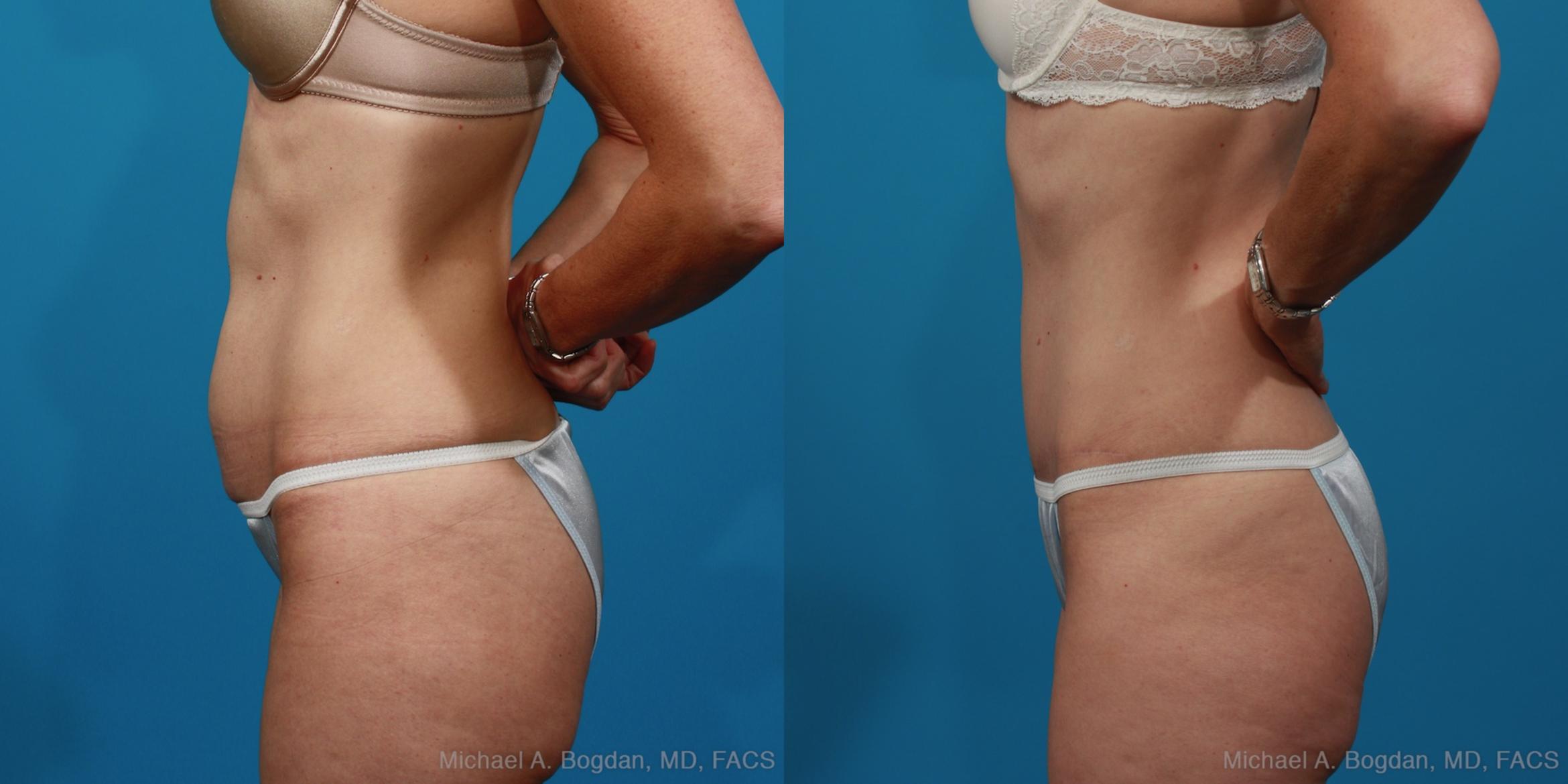 Before & After Tummy Tuck Case 279 View #2 View in Fort Worth & Frisco, Texas
