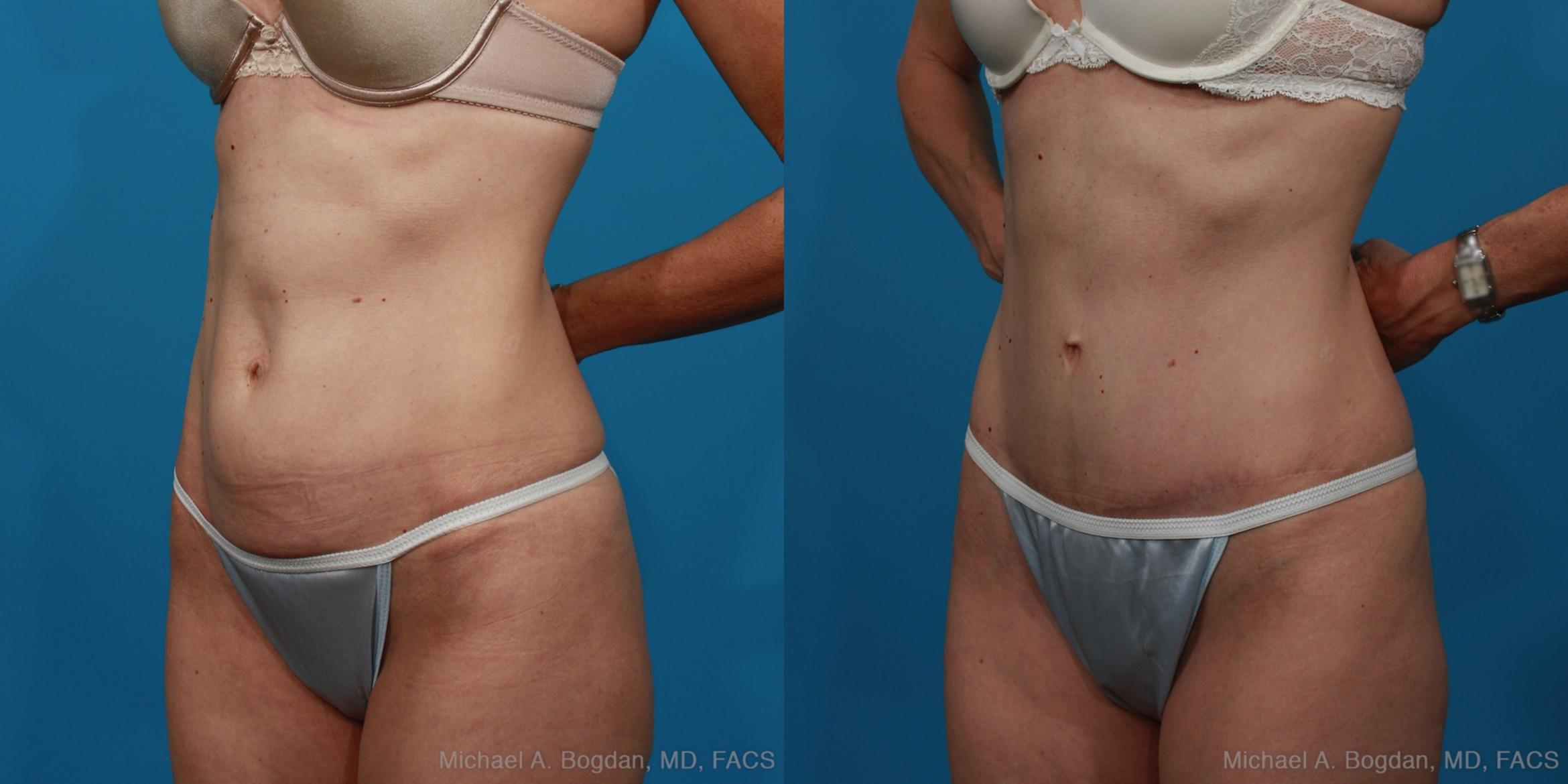 Before & After Tummy Tuck Case 279 View #3 View in Fort Worth & Frisco, Texas
