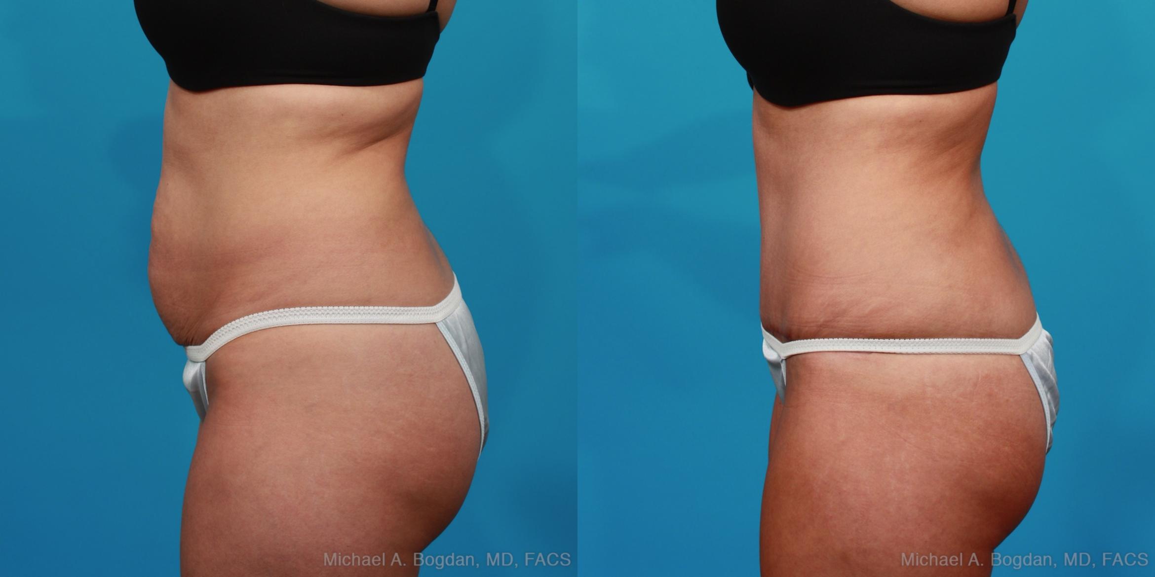 Before & After Tummy Tuck Case 294 View #2 View in Fort Worth & Frisco, Texas