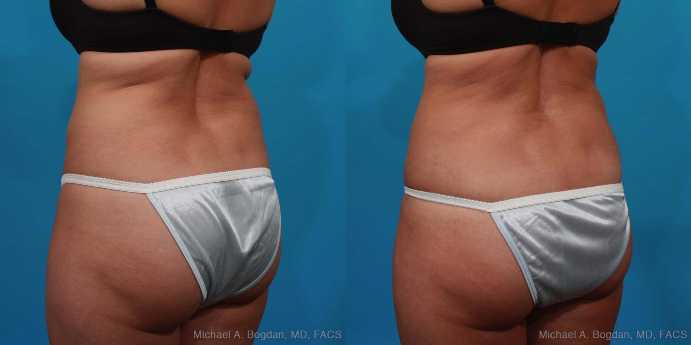 Before & After Tummy Tuck Case 294 View #4 View in Fort Worth & Frisco, Texas