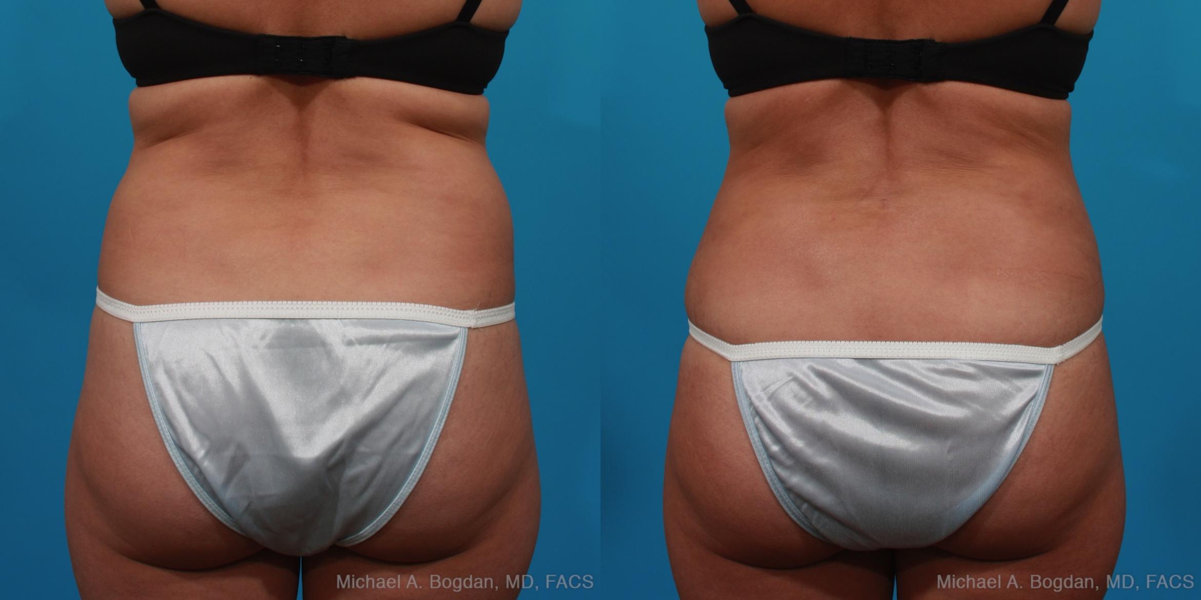 Before & After Tummy Tuck Case 294 View #5 View in Fort Worth & Frisco, Texas