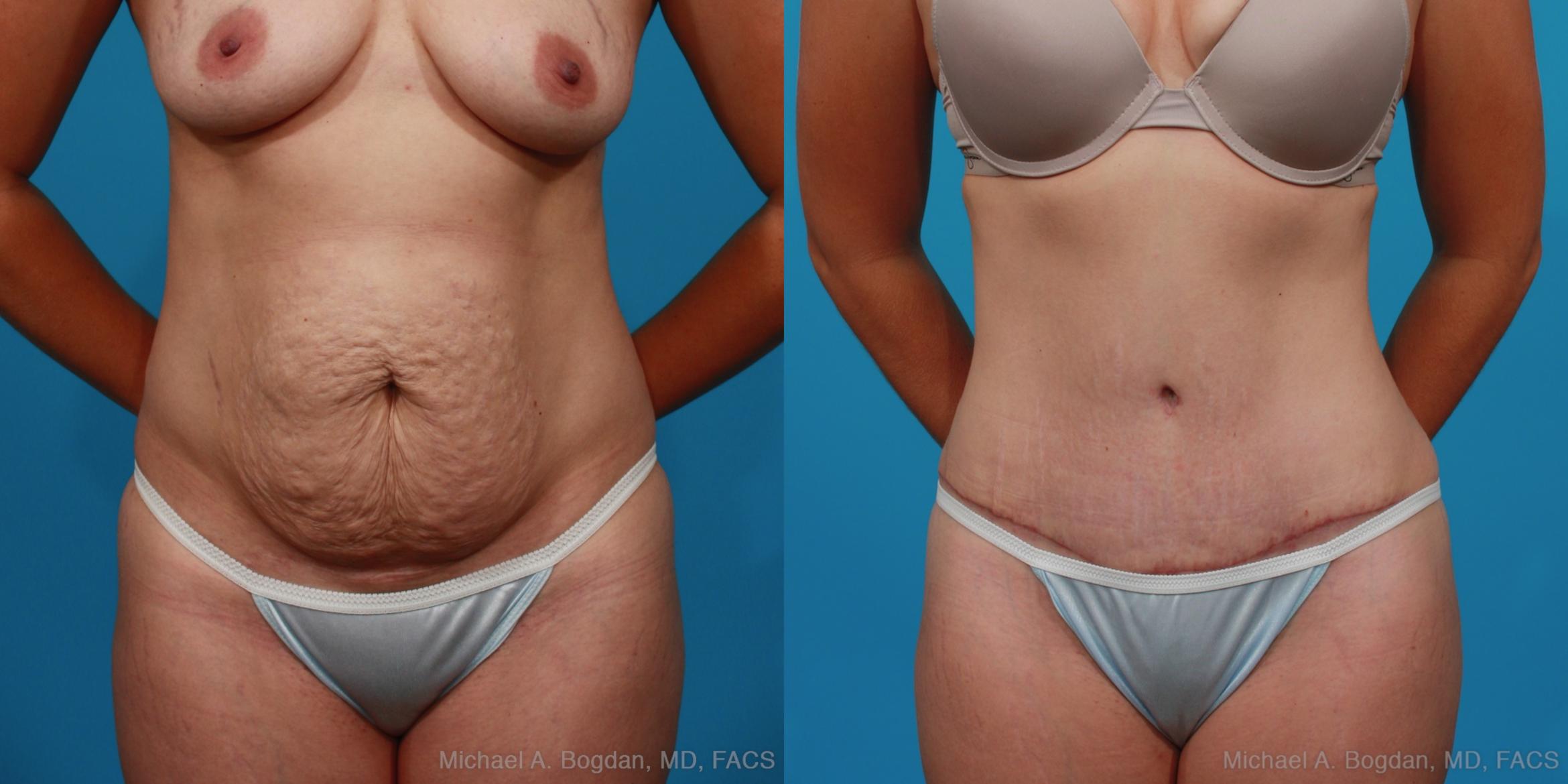 Before & After Tummy Tuck Case 296 View #1 View in Fort Worth & Frisco, Texas