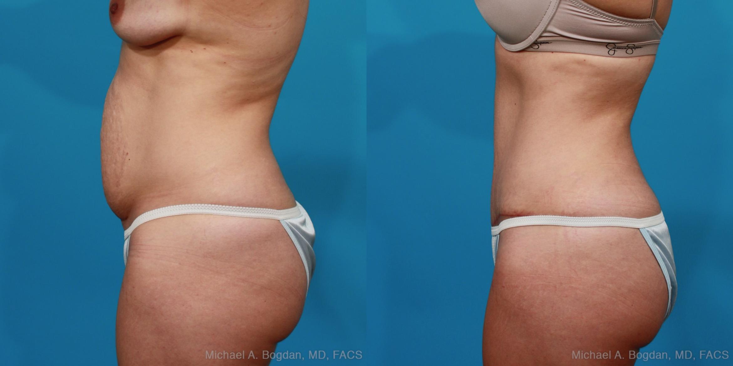Before & After Tummy Tuck Case 296 View #2 View in Fort Worth & Frisco, Texas