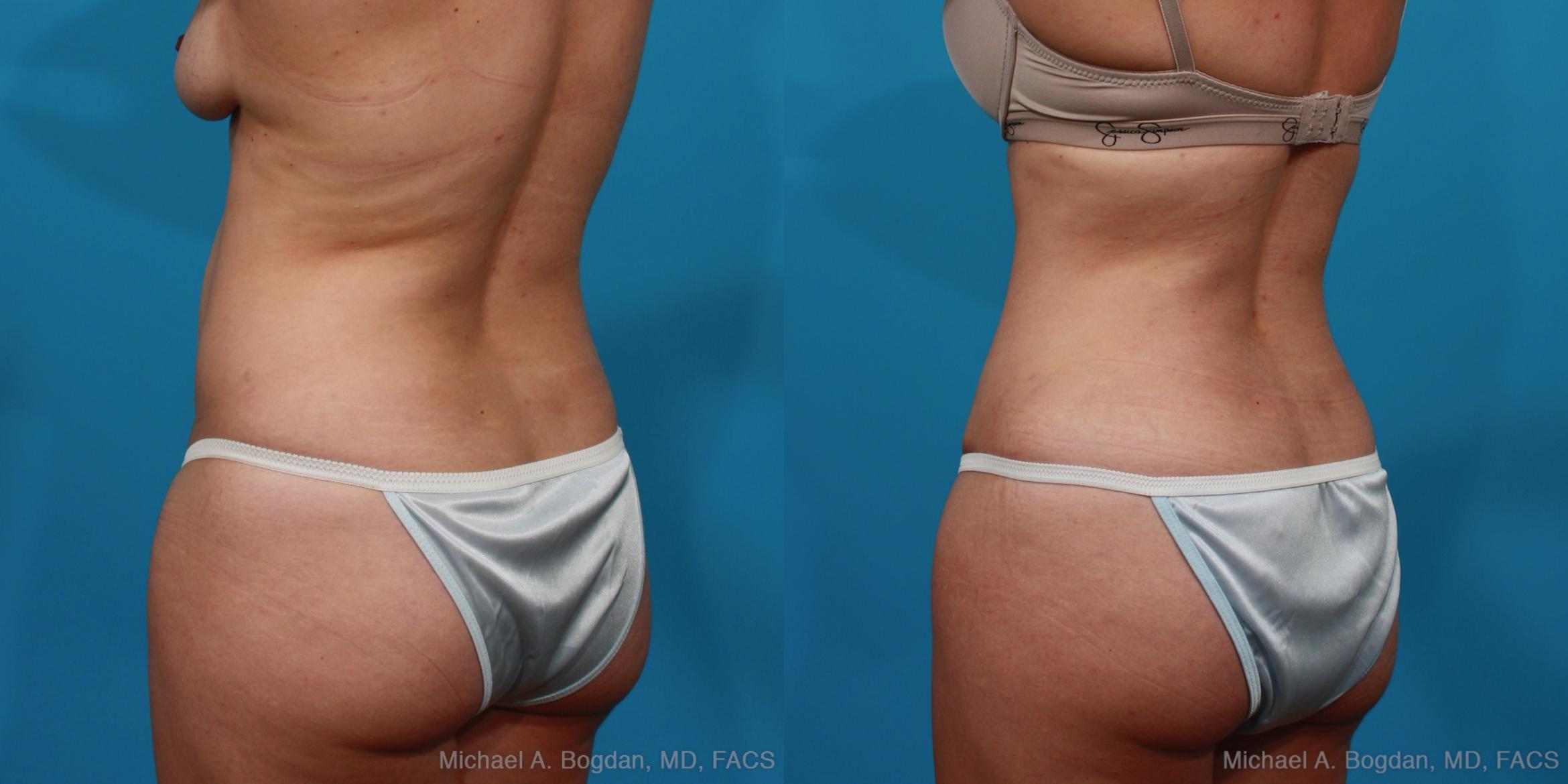 Before & After Tummy Tuck Case 296 View #4 View in Fort Worth & Frisco, Texas