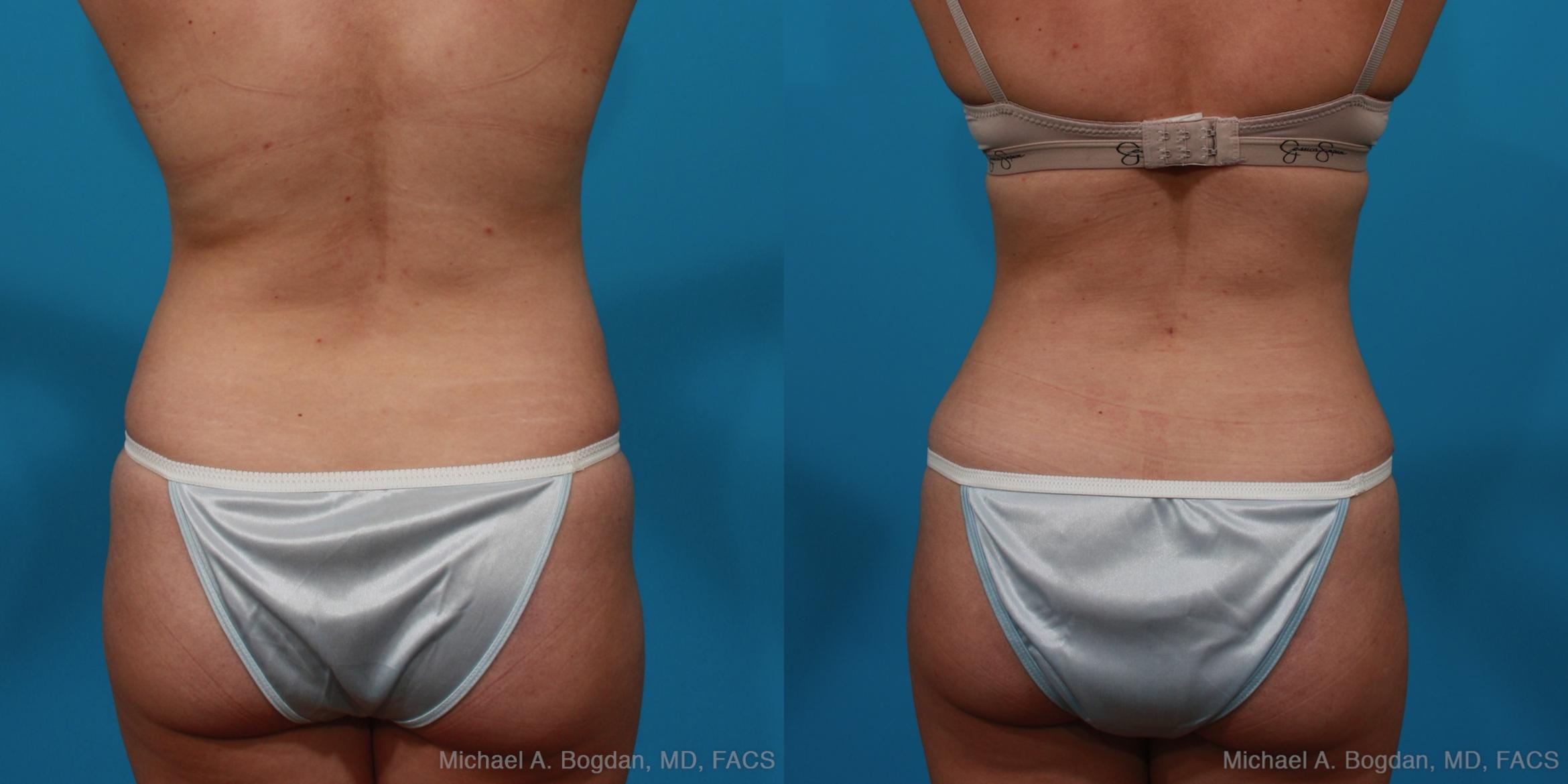 Before & After Tummy Tuck Case 296 View #5 View in Fort Worth & Frisco, Texas