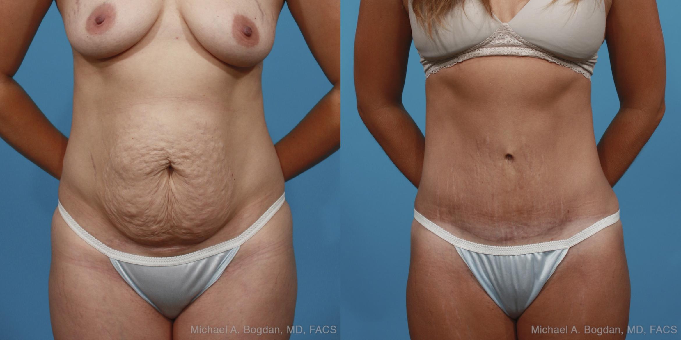 Before & After Tummy Tuck Case 370 View #1 View in Fort Worth & Frisco, Texas