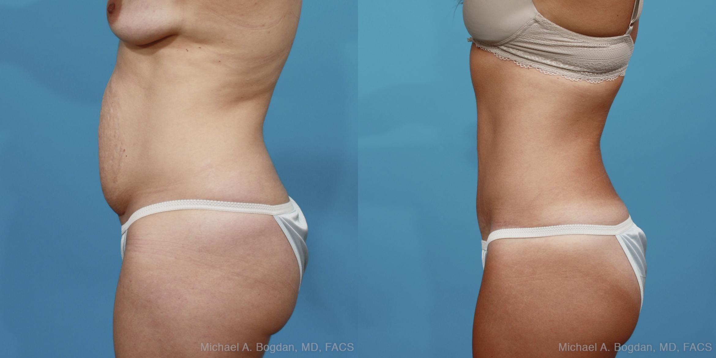 Before & After Tummy Tuck Case 370 View #2 View in Fort Worth & Frisco, Texas