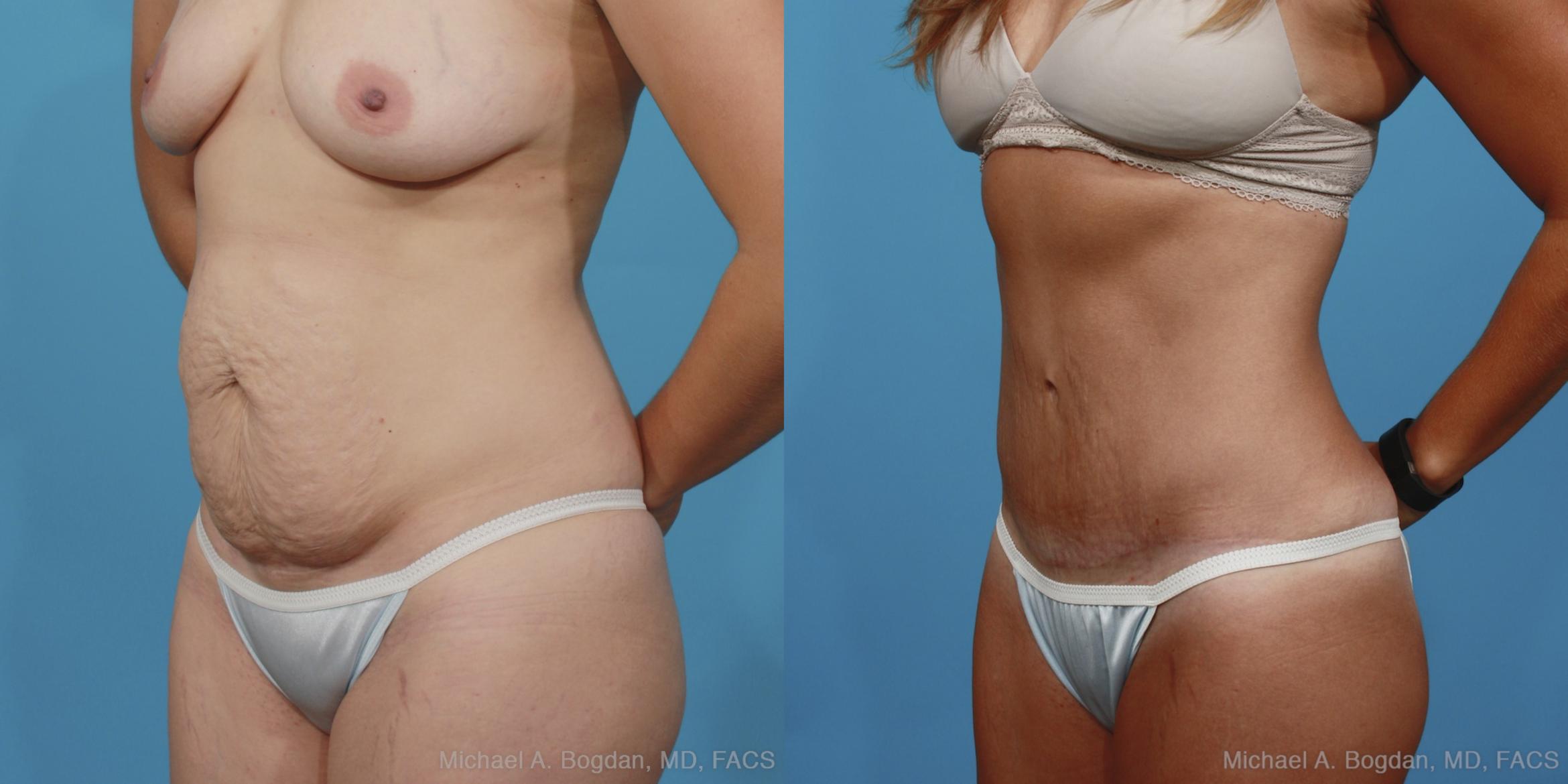 Before & After Tummy Tuck Case 370 View #3 View in Fort Worth & Frisco, Texas