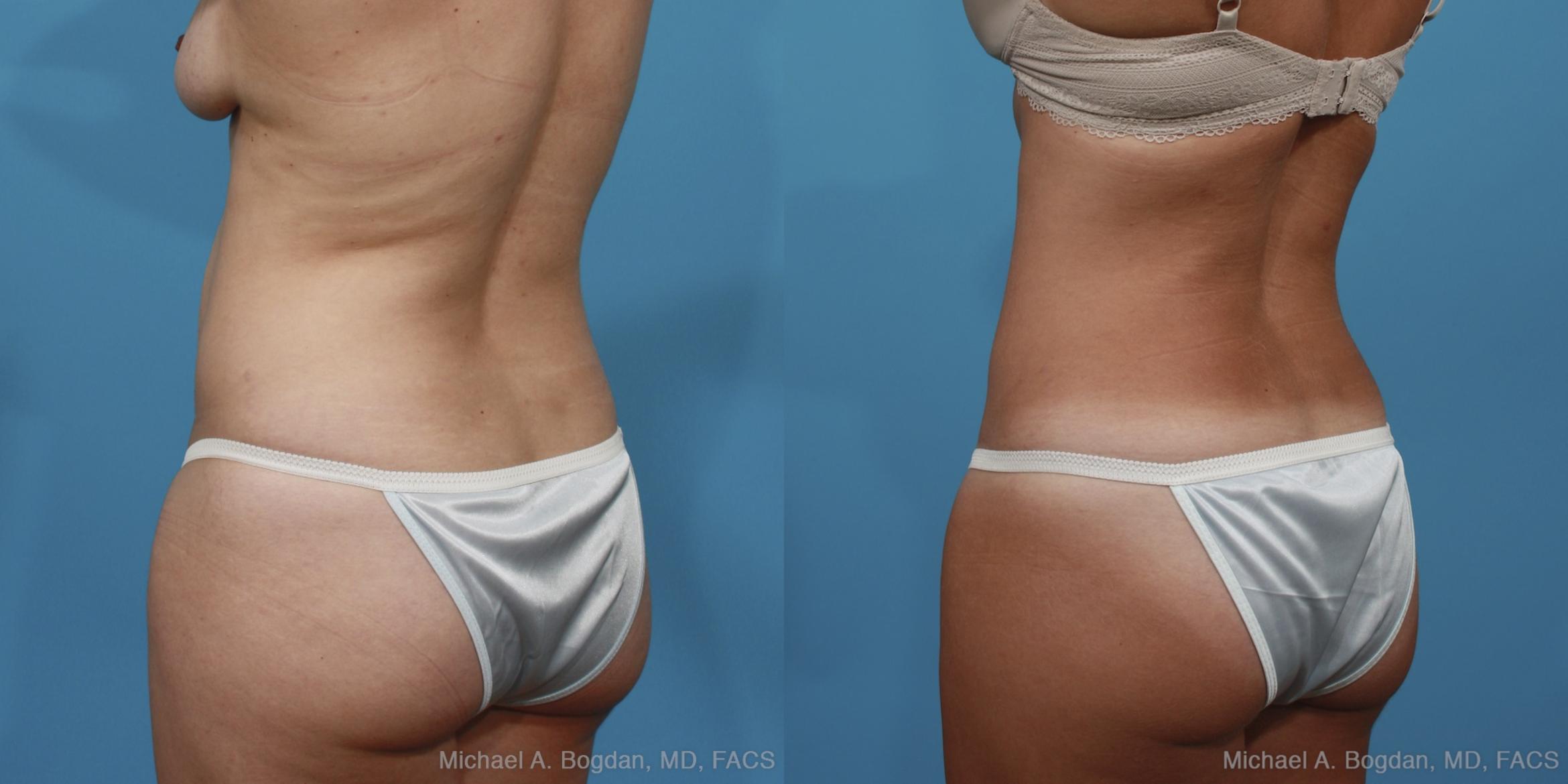 Before & After Tummy Tuck Case 370 View #4 View in Fort Worth & Frisco, Texas