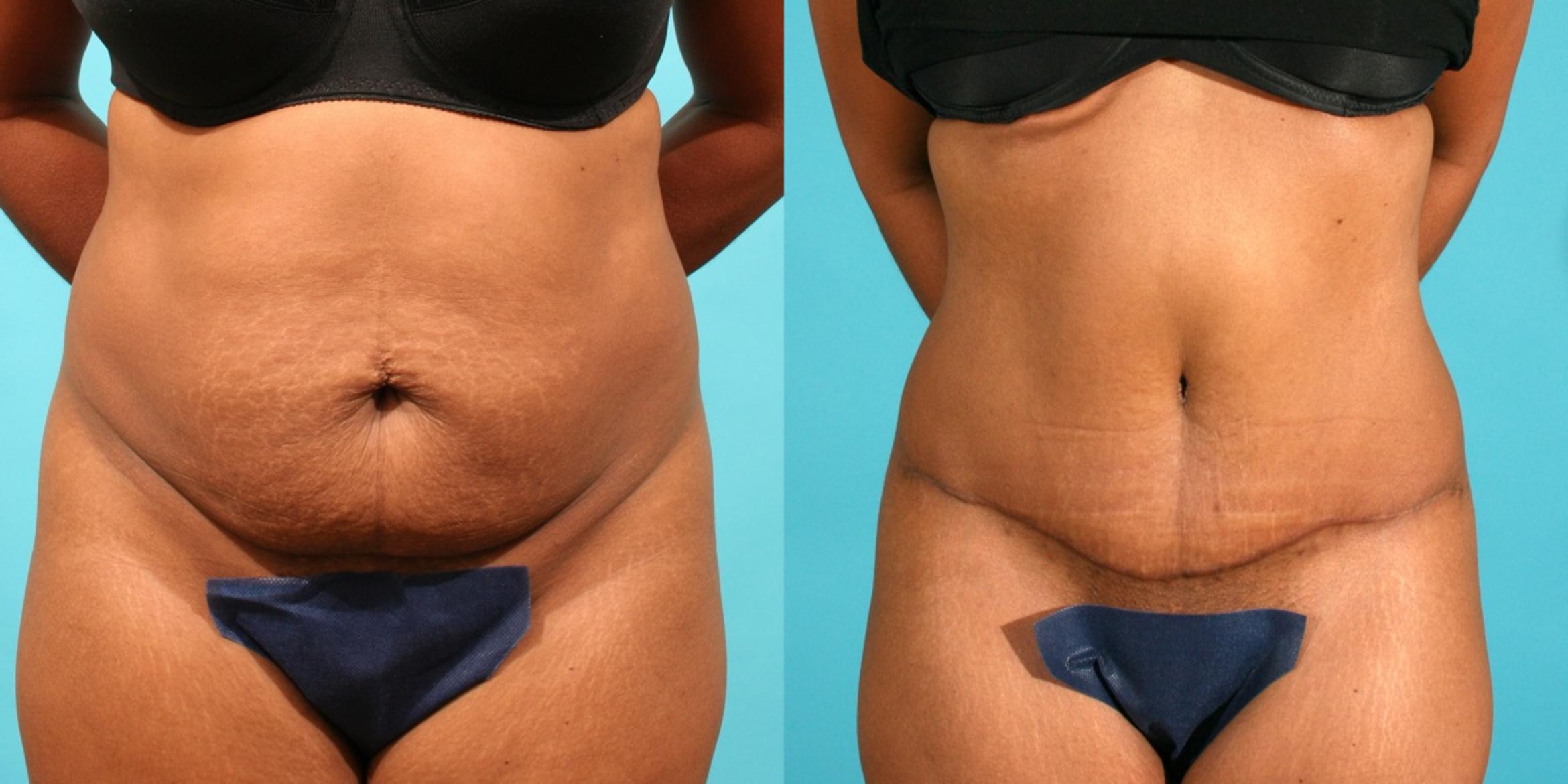 Before & After Tummy Tuck Case 41 View #1 View in Fort Worth & Frisco, Texas