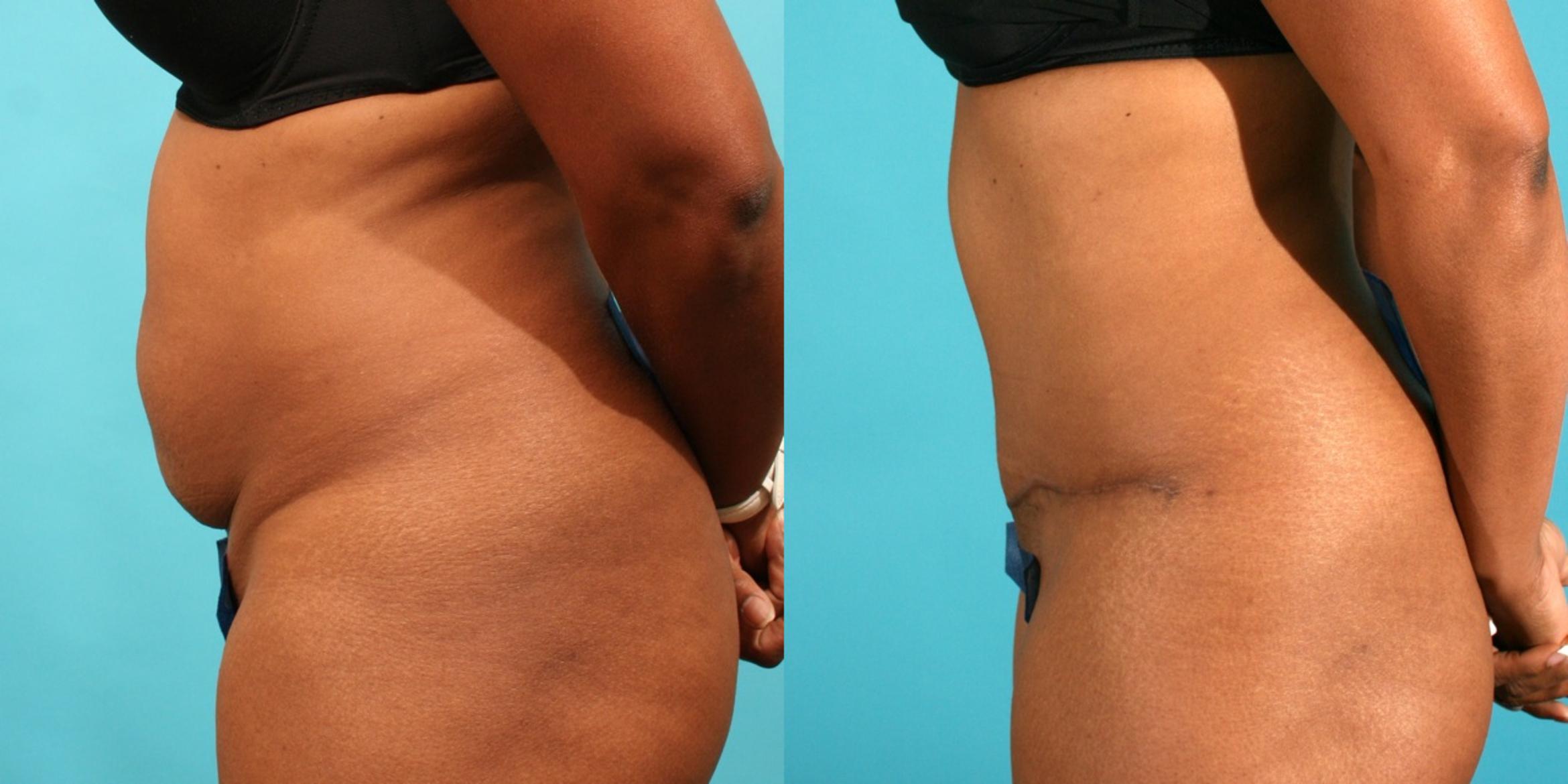 Before & After Tummy Tuck Case 41 View #2 View in Fort Worth & Frisco, Texas
