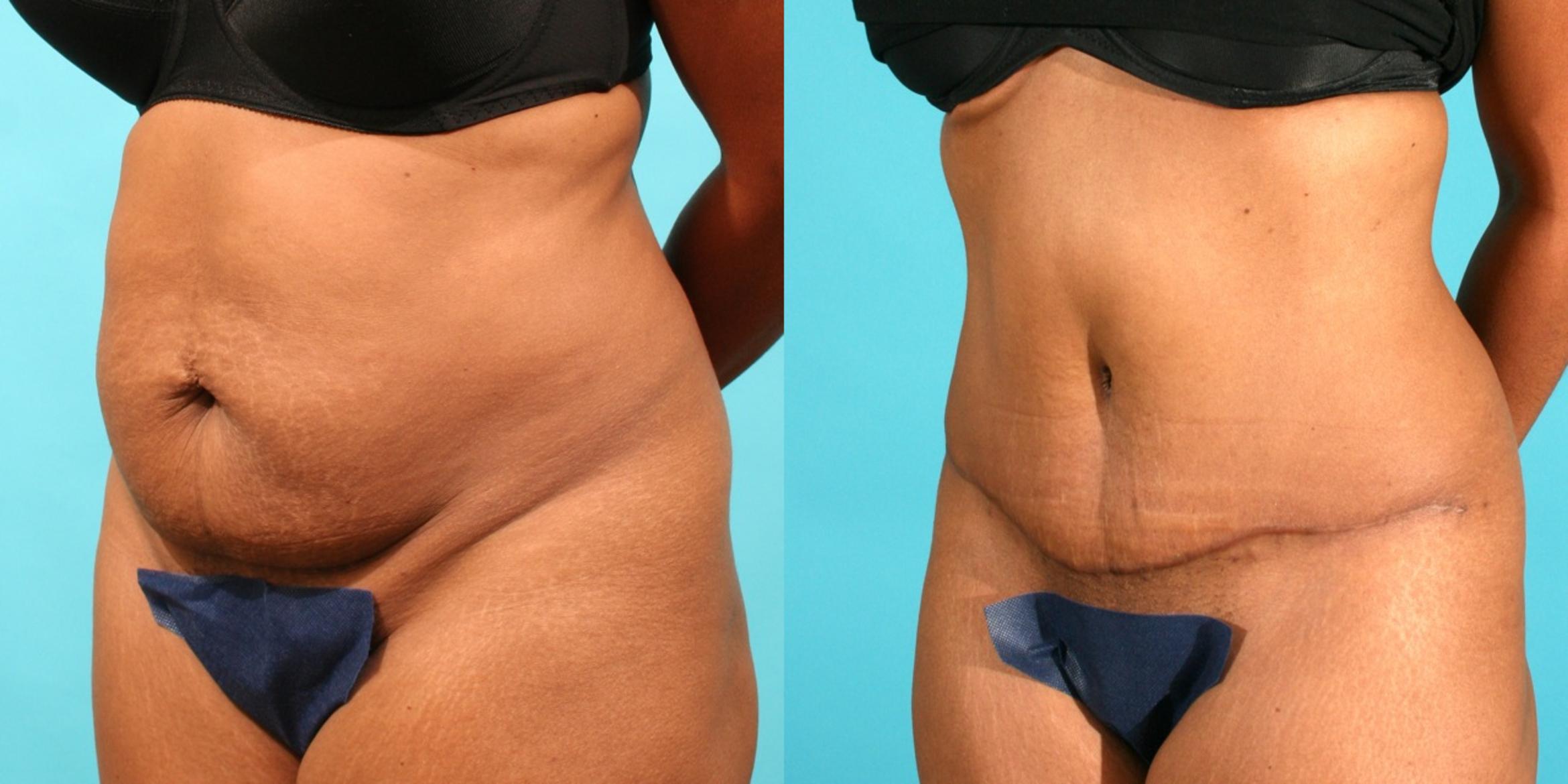 Before & After Tummy Tuck Case 41 View #3 View in Fort Worth & Frisco, Texas