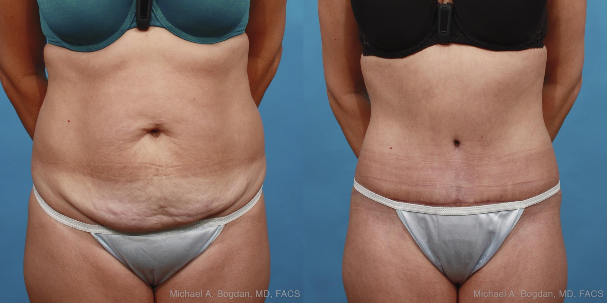 Before & After Tummy Tuck Case 433 View #1 View in Fort Worth & Frisco, Texas