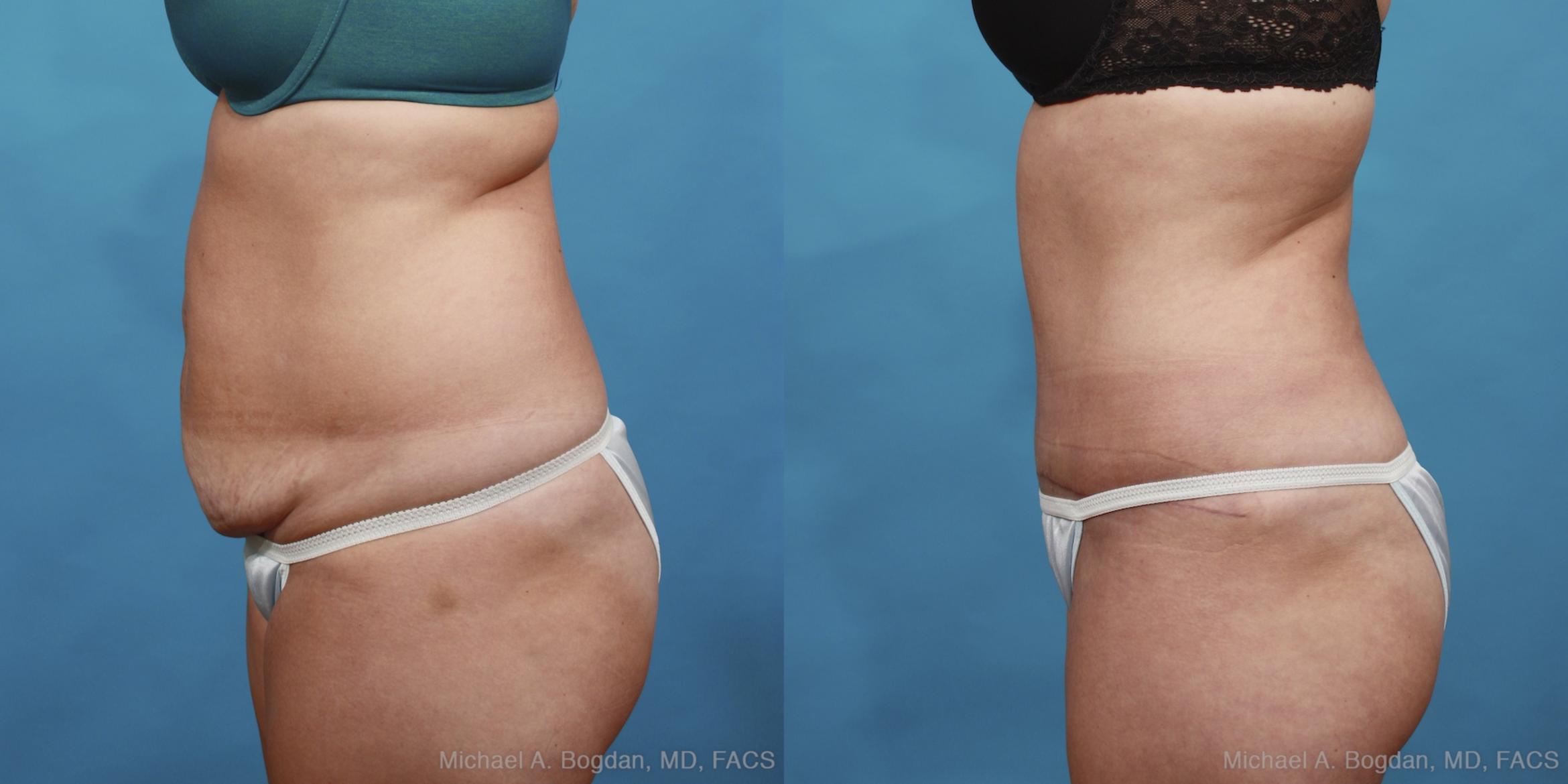 Before & After Tummy Tuck Case 433 View #2 View in Fort Worth & Frisco, Texas