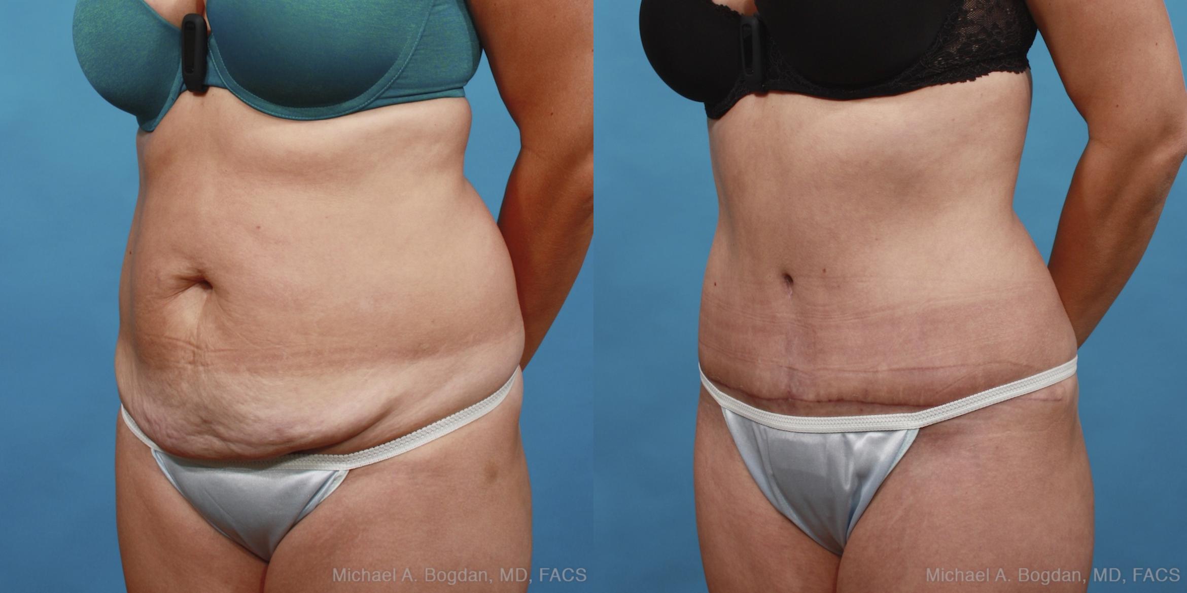Before & After Tummy Tuck Case 433 View #3 View in Fort Worth & Frisco, Texas