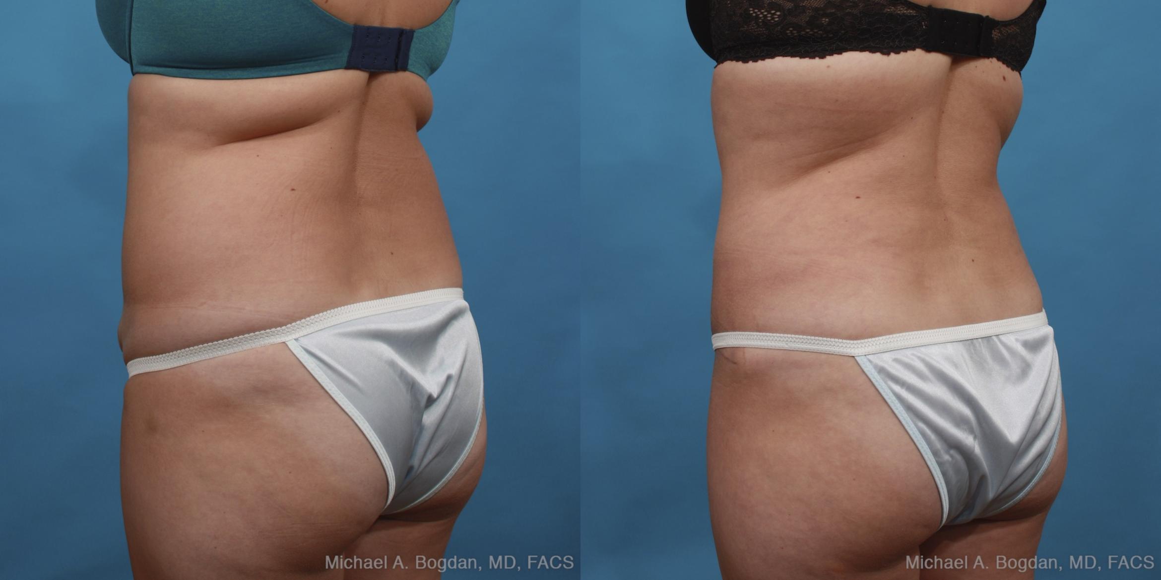 Before & After Tummy Tuck Case 433 View #4 View in Fort Worth & Frisco, Texas