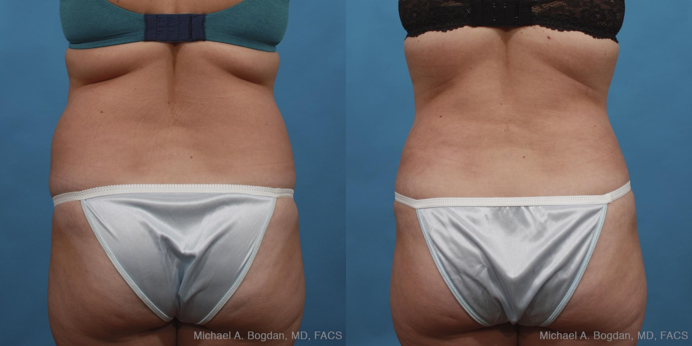 Before & After Tummy Tuck Case 433 View #5 View in Fort Worth & Frisco, Texas