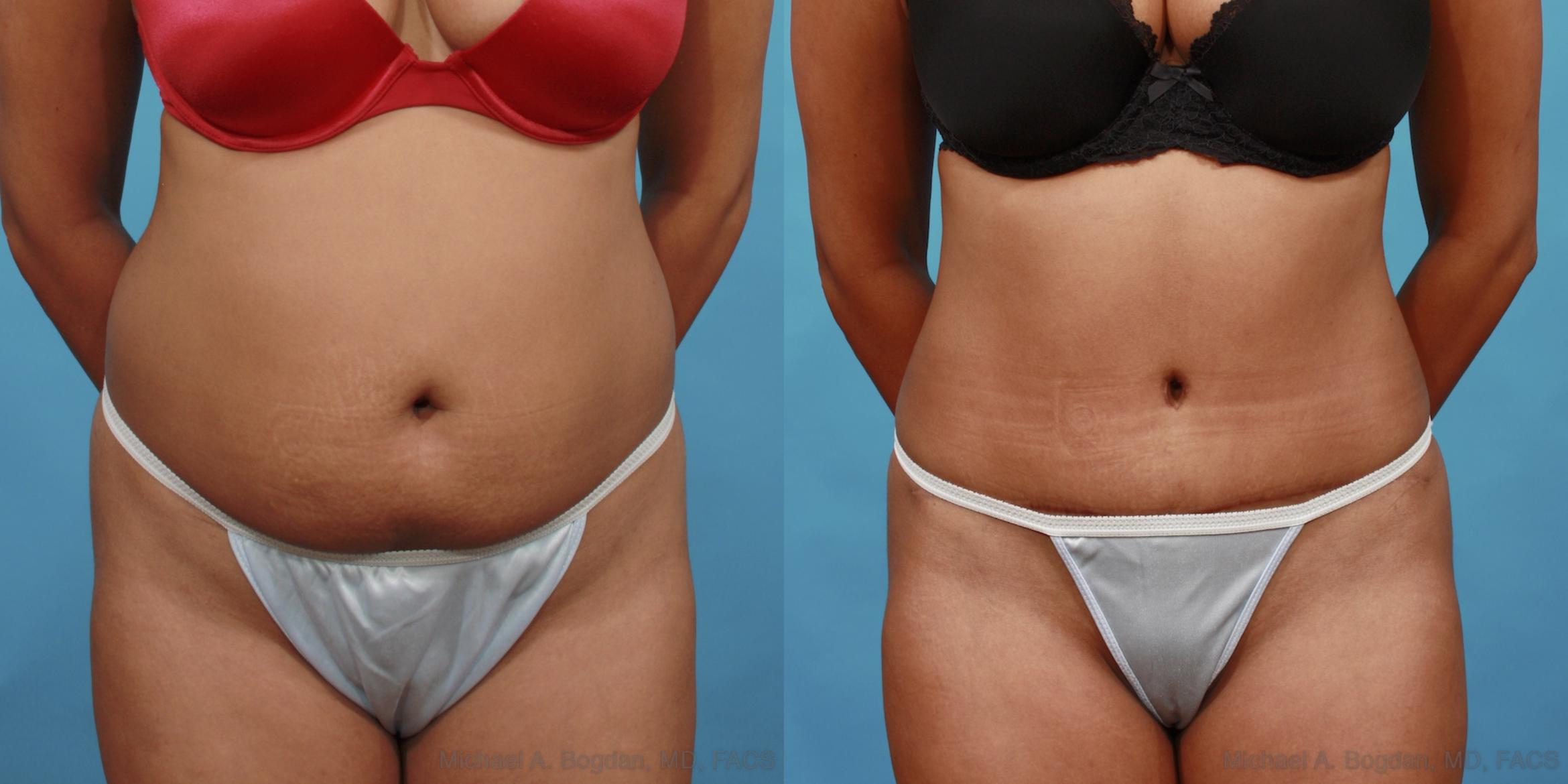 Before & After Tummy Tuck Case 508 View #1 View in Fort Worth & Frisco, Texas