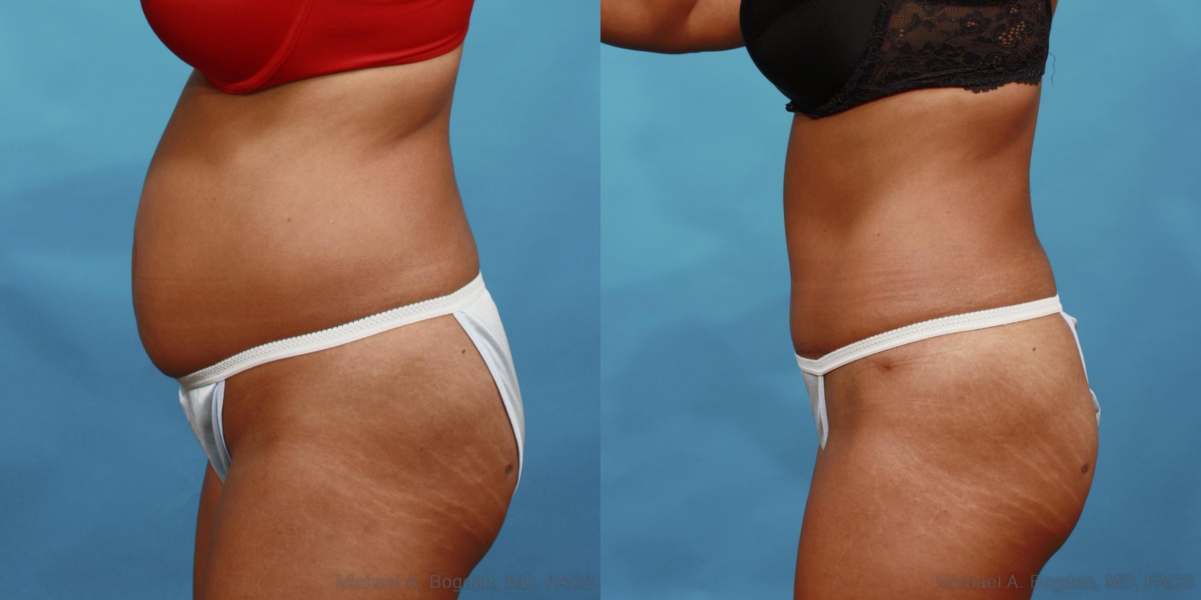Before & After Tummy Tuck Case 508 View #3 View in Fort Worth & Frisco, Texas