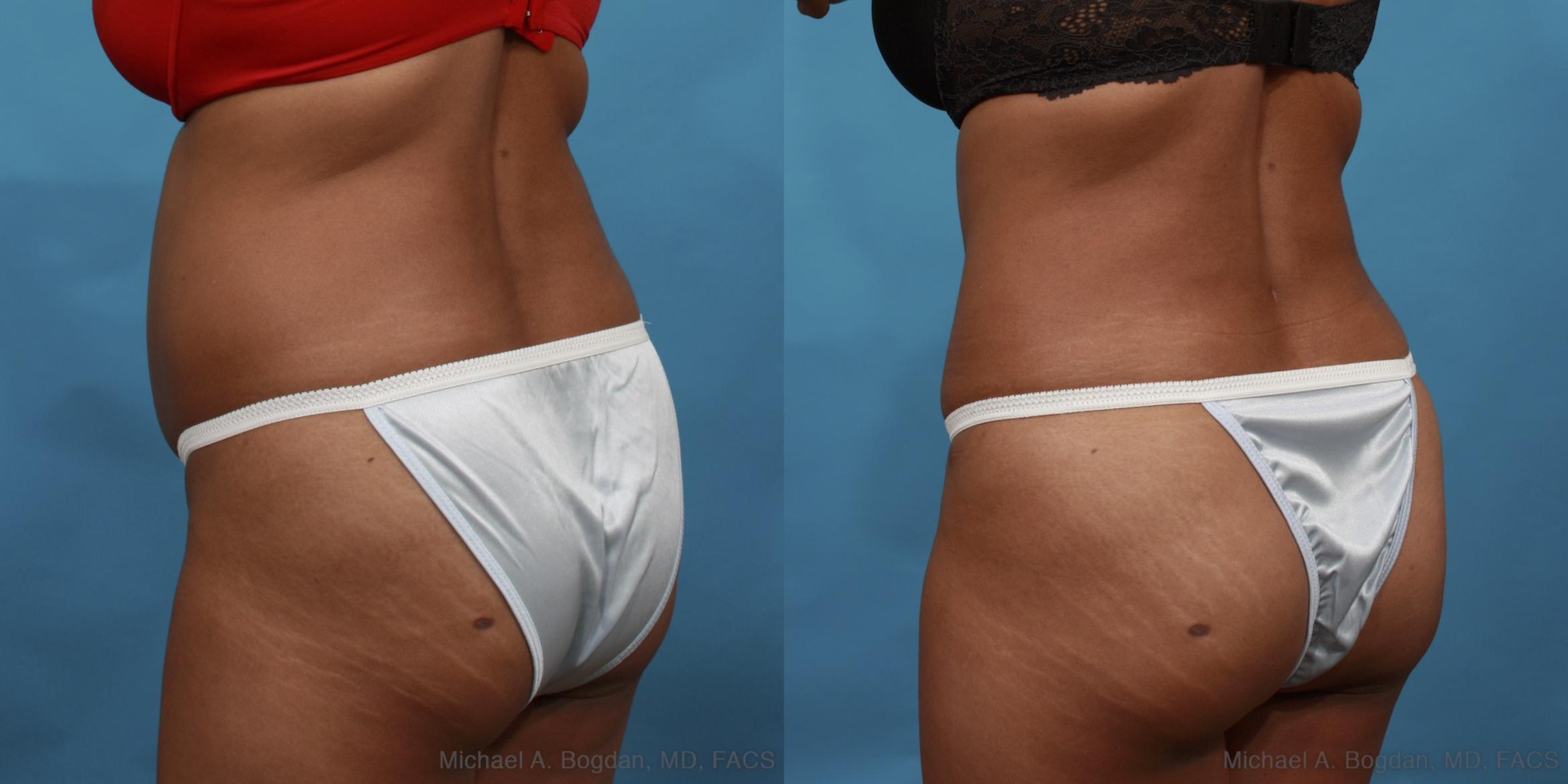 Before & After Tummy Tuck Case 508 View #4 View in Fort Worth & Frisco, Texas