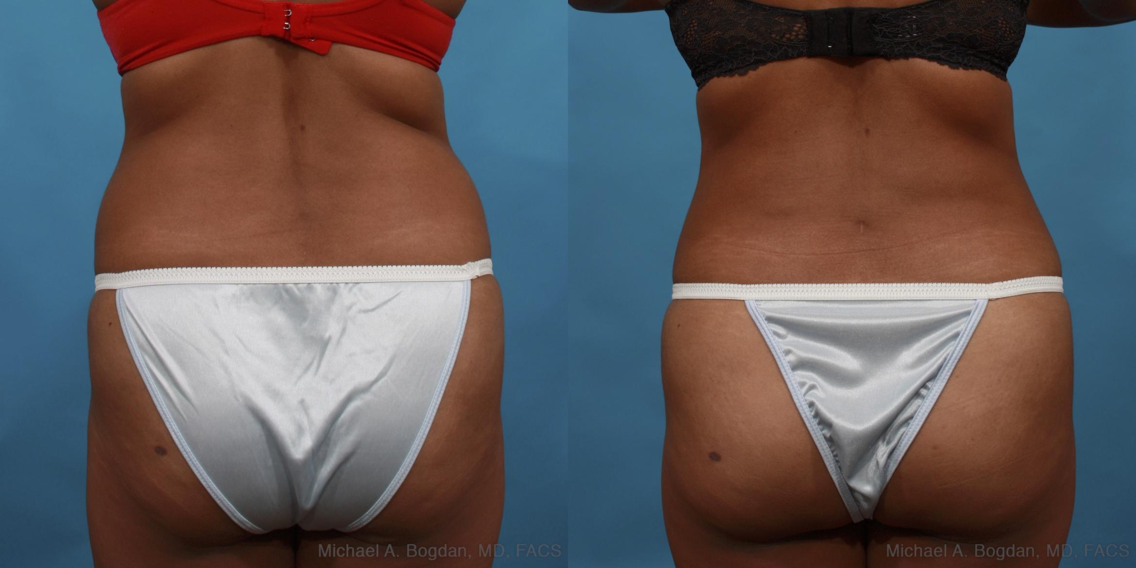 Before & After Tummy Tuck Case 508 View #5 View in Fort Worth & Frisco, Texas
